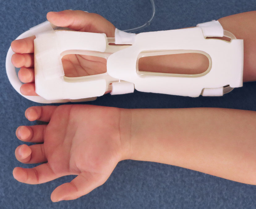 Touch, Look, Compare with the TLC Wrist Splint