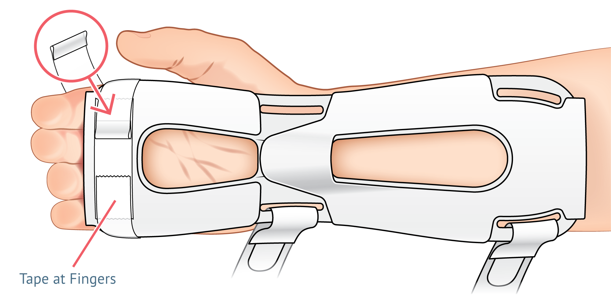 Detail of TLC Wrist Splint Tips and Tricks