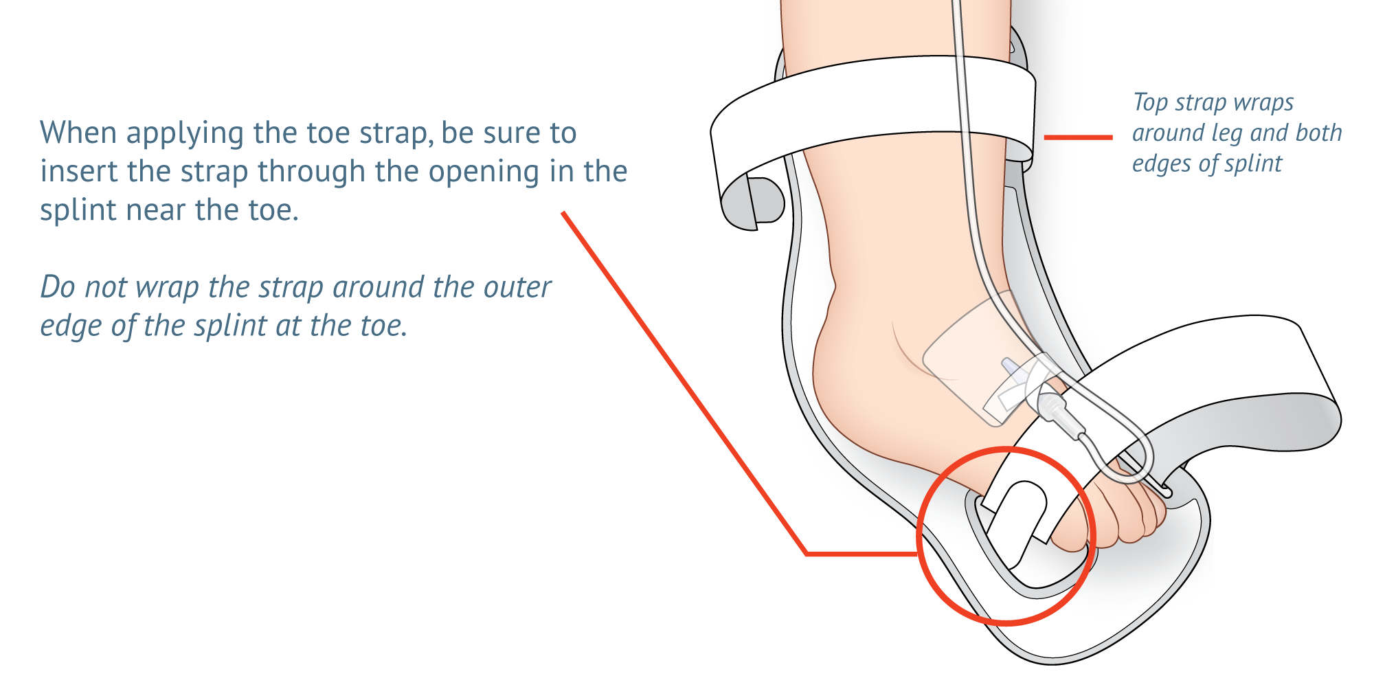 Detail of 949XS Foot Splint Tips and Tricks Sheet