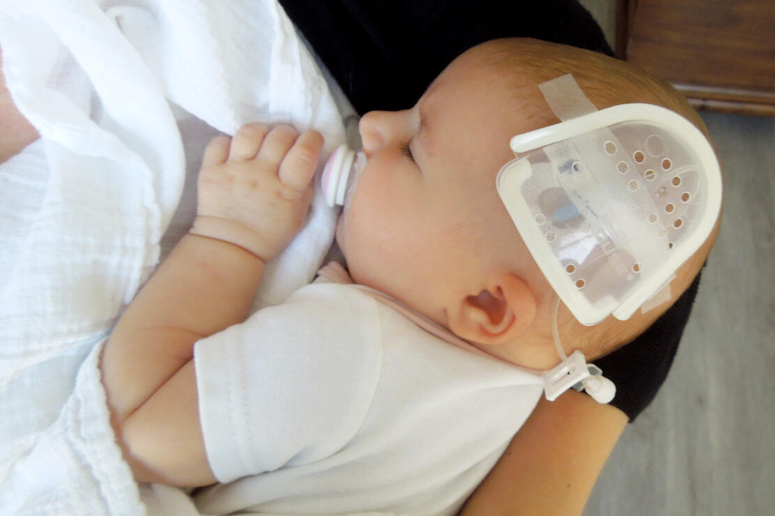 750LFP I.V. House UltraDome on infant's scalp