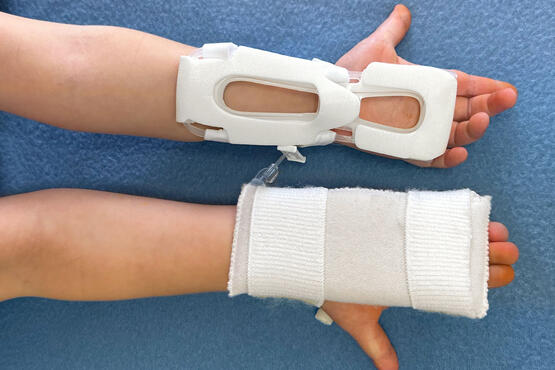 I.V. House TLC Splint vs. Traditional Armboard