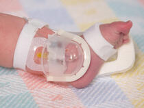 949XS TLC Foot Splint and 727SFP I.V. House UltraDressing on infant
