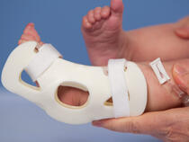 949XS TLC Foot Splint on infant